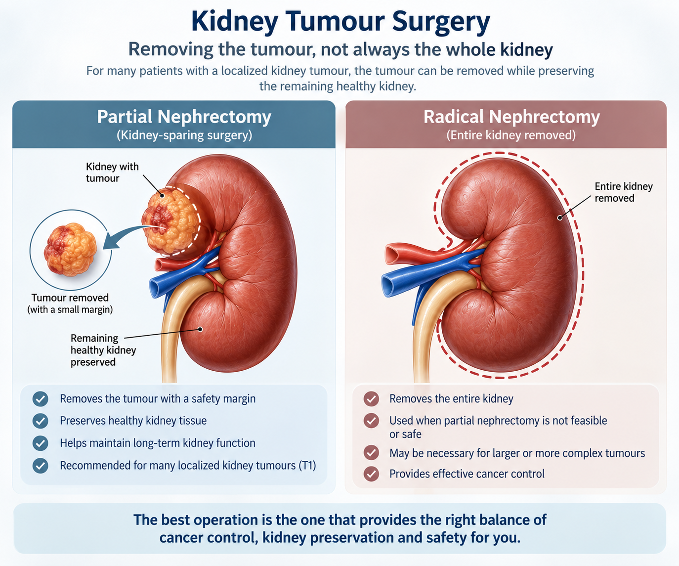 Infographic comparing partial nephrectomy, which removes only the tumour and preserves the kidney, with radical nephrectomy, which removes the entire kidney